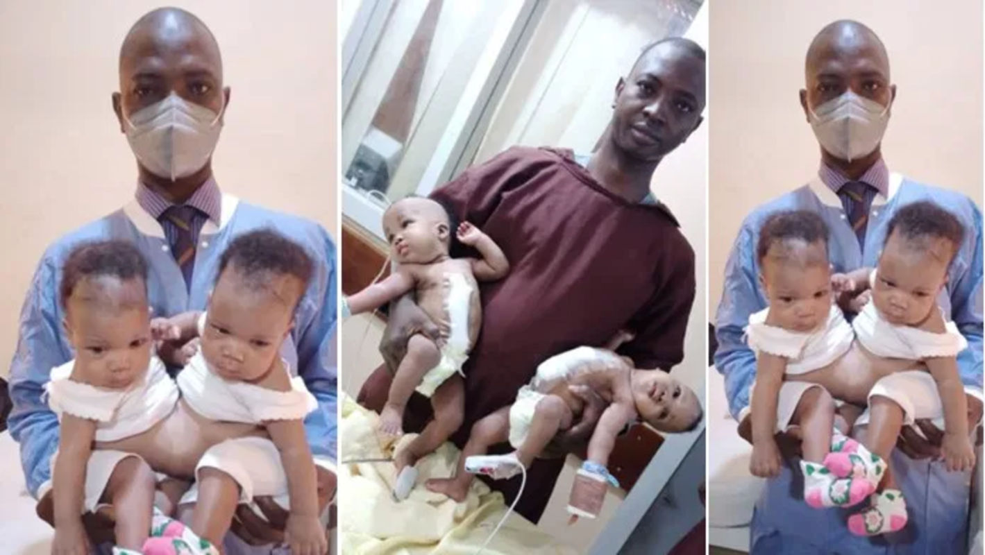 Des jumeaux conjoints séparés avec succès à l'hôpital universitaire d'Ilorin